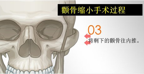 潍坊削颧骨多少钱