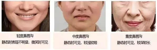 鼻唇沟,让女人看起来衰老10岁,来潍医整形改变吧!